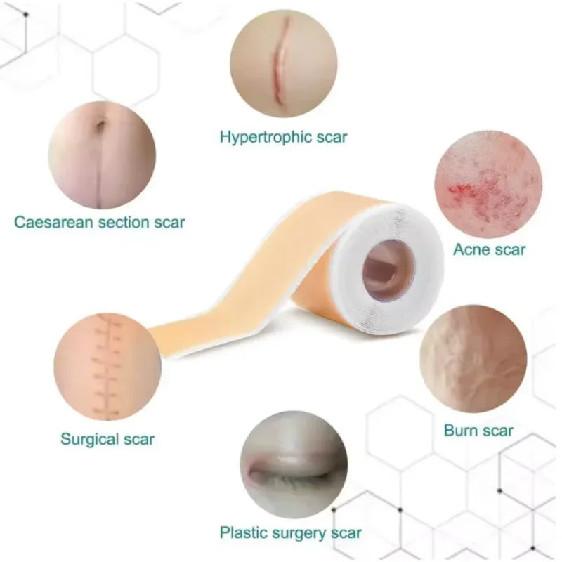 Silicone Scar Removal Tape for Surgery and Burn Scars - 5