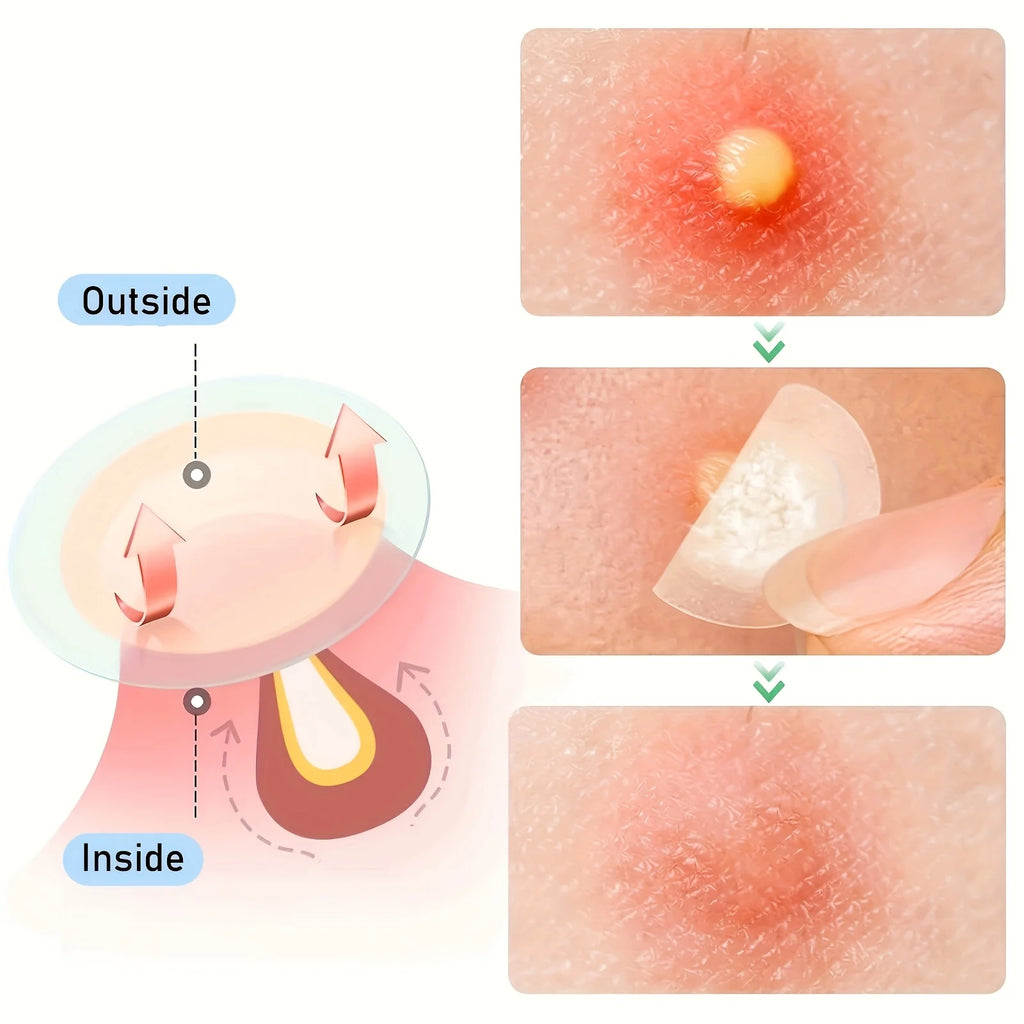 Cute Hydrocolloid Acne Pimple Patches